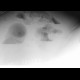 Ileus, pneumoperitoneum, peritonitis: X-ray - Plain radiograph
